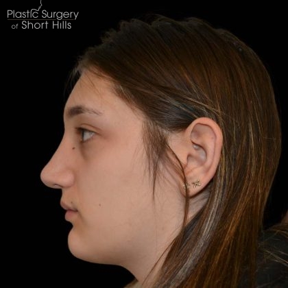 Rhinoplasty Before & After Patient #16258