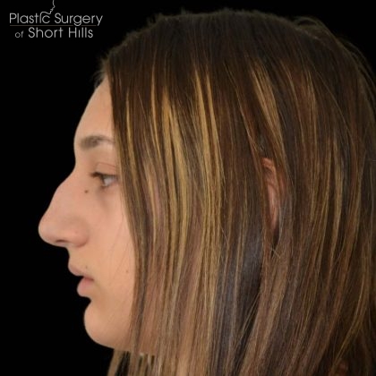 Rhinoplasty Before & After Patient #16258