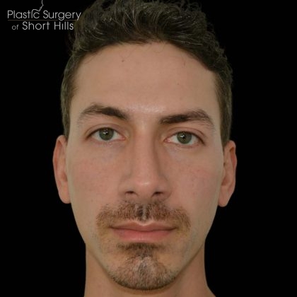 Revision Rhinoplasty Before & After Patient #16317