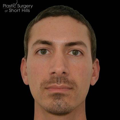 Revision Rhinoplasty Before & After Patient #16317