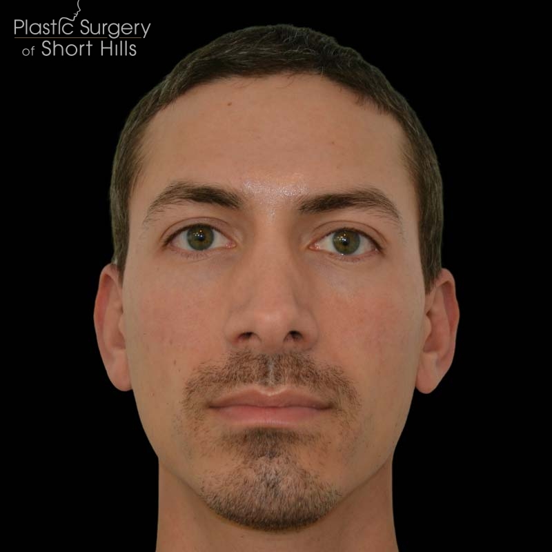 Revision Rhinoplasty Before & After Patient #16317