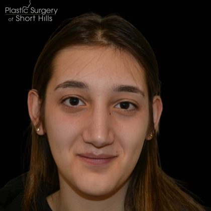 Rhinoplasty Before & After Patient #16258
