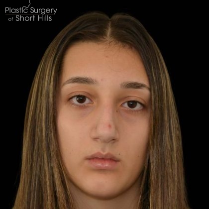 Rhinoplasty Before & After Patient #16258