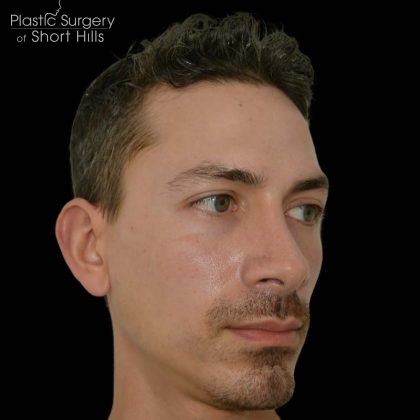Revision Rhinoplasty Before & After Patient #16317