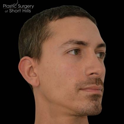 Revision Rhinoplasty Before & After Patient #16317