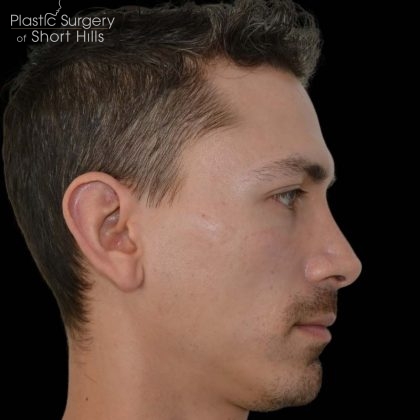 Revision Rhinoplasty Before & After Patient #16317