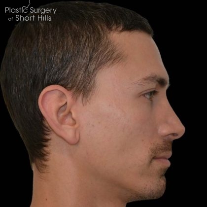 Revision Rhinoplasty Before & After Patient #16317