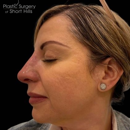 Liquid Rhinoplasty(Non-Surgical) Before & After Patient #16241