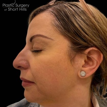 Liquid Rhinoplasty(Non-Surgical) Before & After Patient #16241