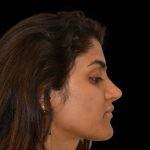 Rhinoplasty Before & After Patient #16216