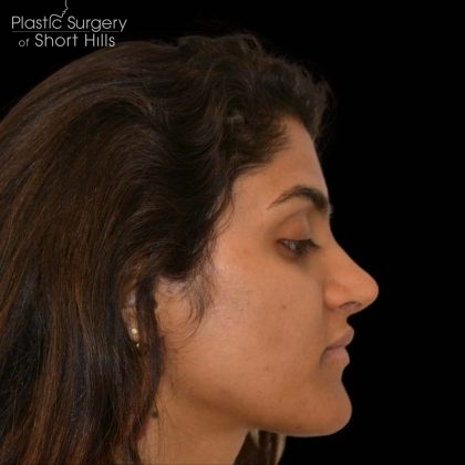 Rhinoplasty Before & After Patient #16216