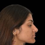 Rhinoplasty Before & After Patient #16216