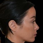 Revision Rhinoplasty Before & After Patient #16316