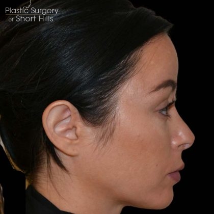 Revision Rhinoplasty Before & After Patient #16316