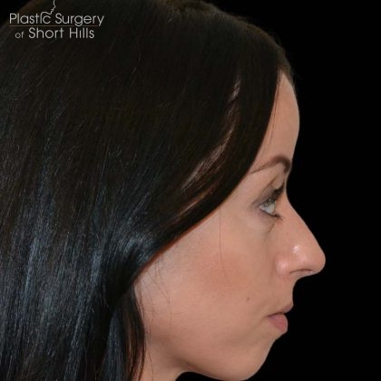 Revision Rhinoplasty Before & After Patient #16316