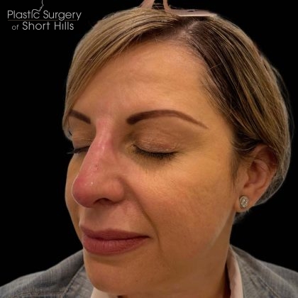 Liquid Rhinoplasty(Non-Surgical) Before & After Patient #16241