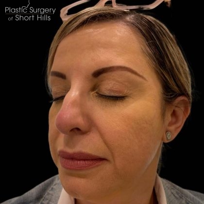 Liquid Rhinoplasty(Non-Surgical) Before & After Patient #16241