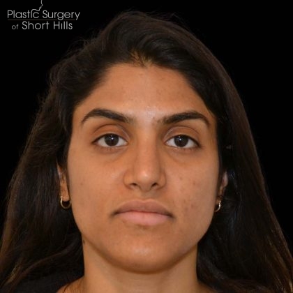 Rhinoplasty Before & After Patient #16216