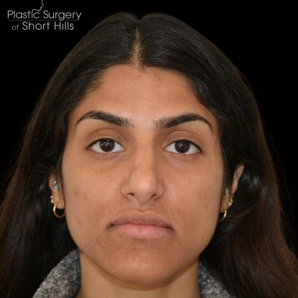 Rhinoplasty Before & After Patient #16216