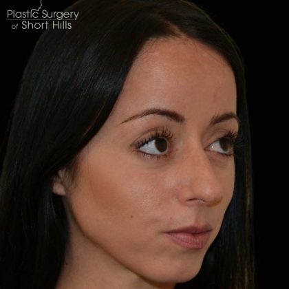 Revision Rhinoplasty Before & After Patient #16316