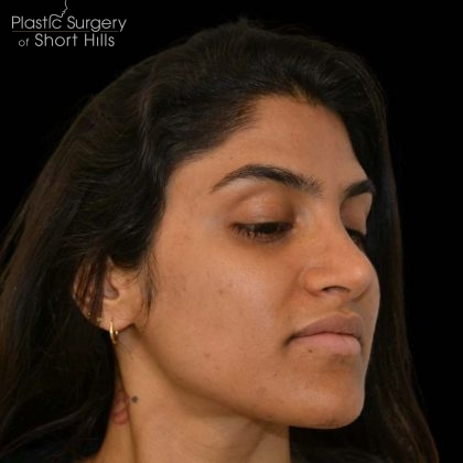 Rhinoplasty Before & After Patient #16216