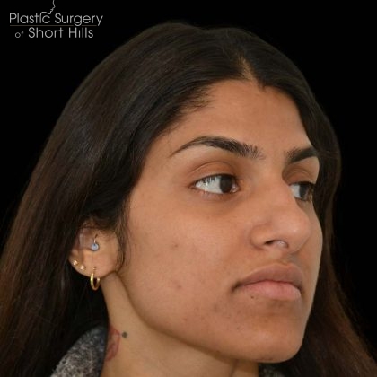 Rhinoplasty Before & After Patient #16216