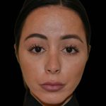 Revision Rhinoplasty Before & After Patient #16316