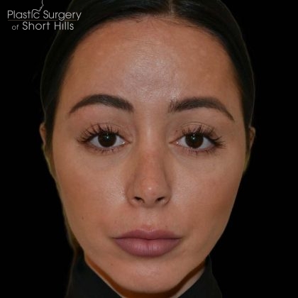 Revision Rhinoplasty Before & After Patient #16316