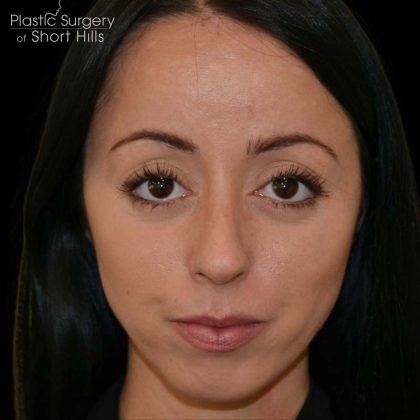 Revision Rhinoplasty Before & After Patient #16316