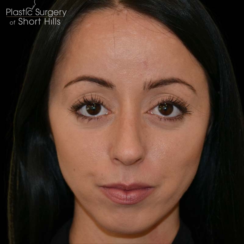 Revision Rhinoplasty Before & After Patient #16316
