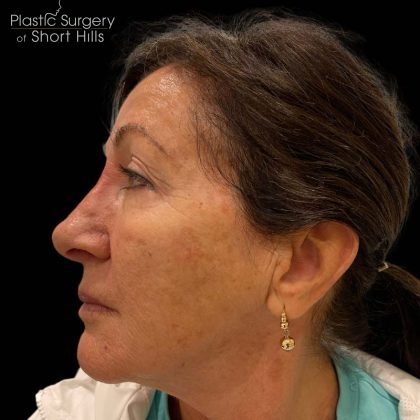 Liquid Rhinoplasty(Non-Surgical) Before & After Patient #16240