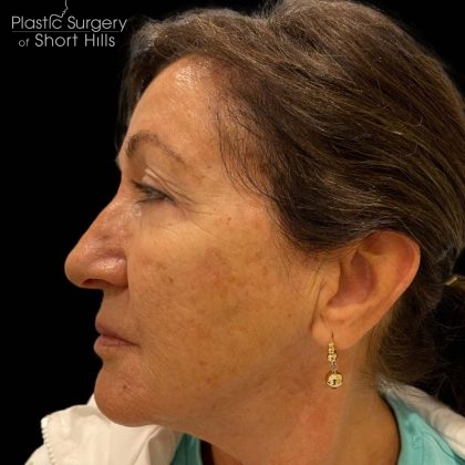 Liquid Rhinoplasty(Non-Surgical) Before & After Patient #16240