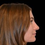 Revision Rhinoplasty Before & After Patient #16215