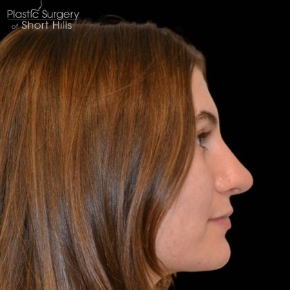 Revision Rhinoplasty Before & After Patient #16215