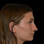 Revision Rhinoplasty Before & After Patient #16215