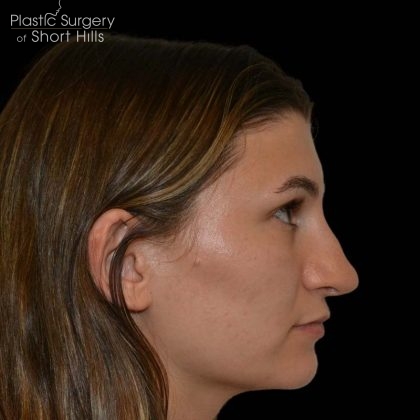 Revision Rhinoplasty Before & After Patient #16215