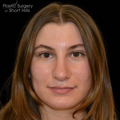 Revision Rhinoplasty Before & After Patient #16215