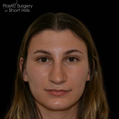 Revision Rhinoplasty Before & After Patient #16215