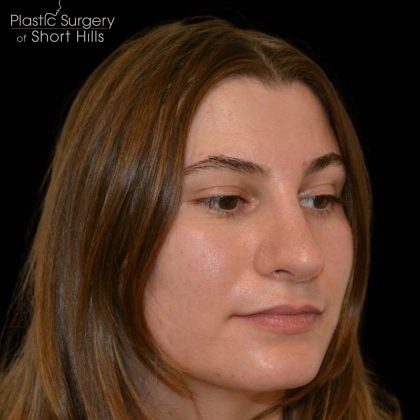 Revision Rhinoplasty Before & After Patient #16215