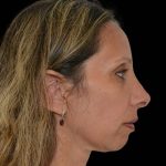 Revision Rhinoplasty Before & After Patient #16315