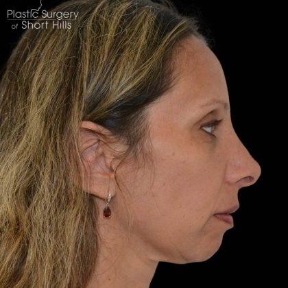 Revision Rhinoplasty Before & After Patient #16315