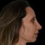 Revision Rhinoplasty Before & After Patient #16315