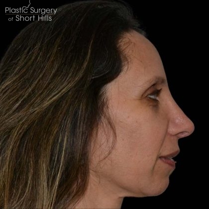 Revision Rhinoplasty Before & After Patient #16315