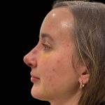 Rhinoplasty Before & After Patient #16214