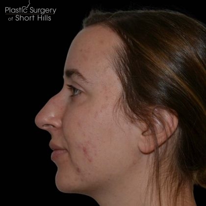 Rhinoplasty Before & After Patient #16214