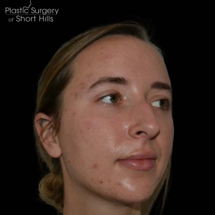 Rhinoplasty Before & After Patient #16214