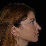 Rhinoplasty Before & After Patient #16210