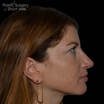 Rhinoplasty Before & After Patient #16210