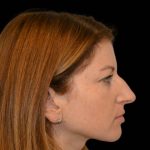 Rhinoplasty Before & After Patient #16210