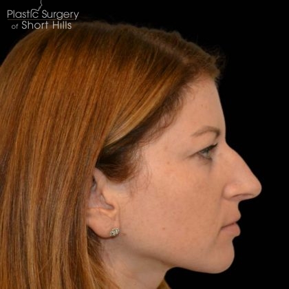 Rhinoplasty Before & After Patient #16210